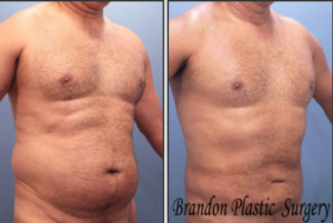 What are the treatment options for gynecomastia?