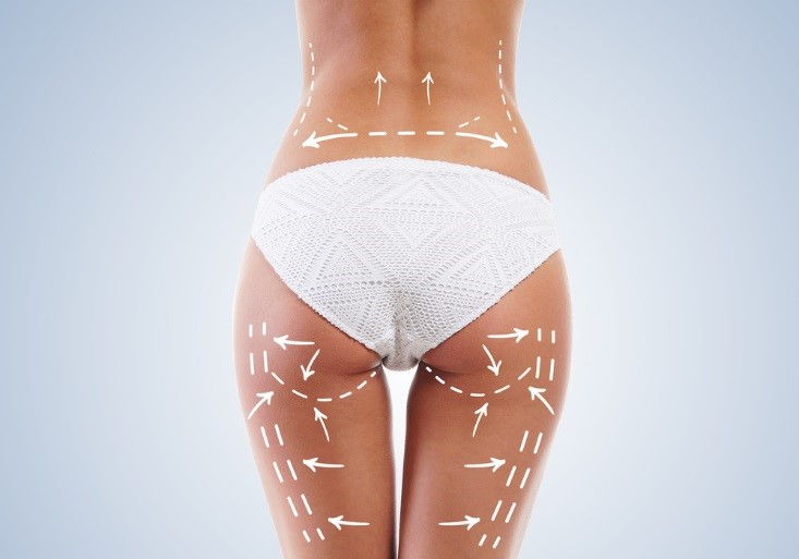 What You Should Know about Liposuction and Tummy Tucks