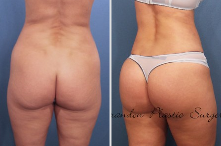 Buttock Augmentation Basics