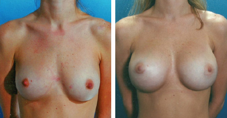 Reasons for Breast Augmentation Revision