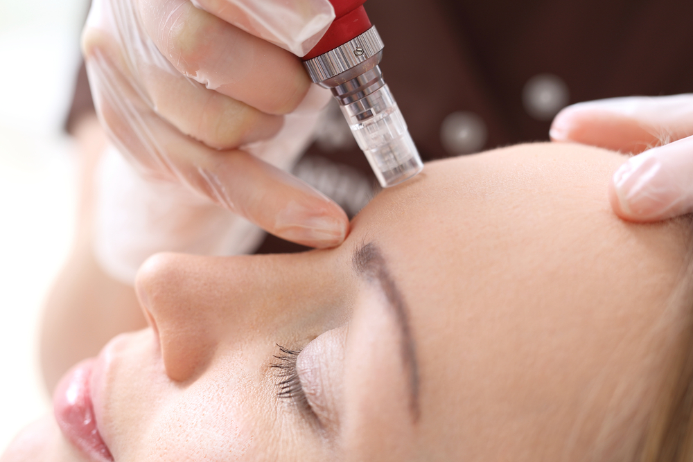 Rejuvenezca su piel este otoño con Microneedling