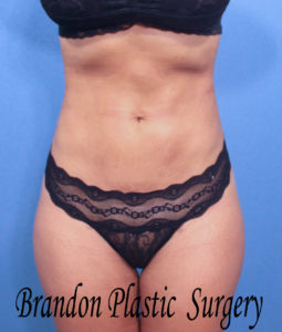 Mini Tummy Tuck Before and After