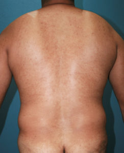 Patient 8284, Flank-Lower Back Liposuction, Male Liposuction Gallery