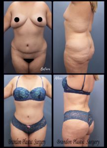 Improve Your Results With Revision Tummy Tuck Surgery - Houston, Texas