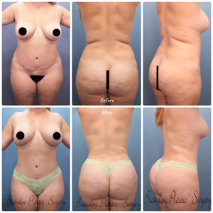 How To Know You Are A Good Tummy Tuck Candidate? – Blog – Profile